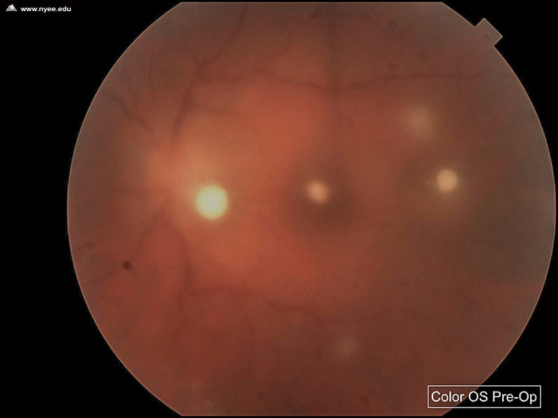 Candida Endophthalmitis (1 of 6) NYEE
